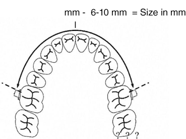 Łuk dystalizujący zęba trzonowego, rozmiar 3 (86 mm)